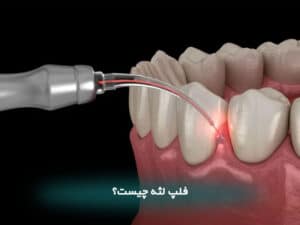 فلپ لثه چیست؟
