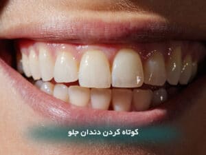 کوتاه کردن دندان جلو