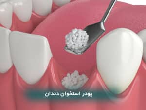پودر اسنخوان دندان