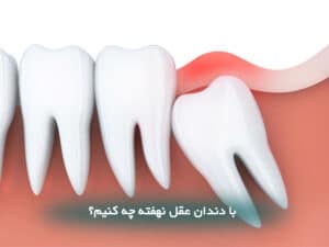 با دندان عقل نهفته چه کنیم؟