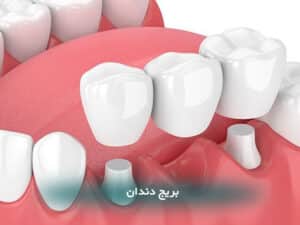 بریج دندان