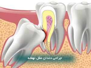 جراحی دندان عقل نهفته