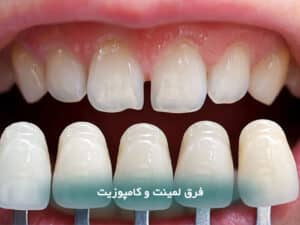 فرق لمینت و کامپوزیت